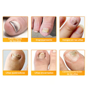 Pegatinas para la onicomicosis