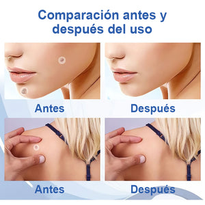 Pegatina para eliminar verrugas y lunares (compre 1 y obtenga 1 gratis)