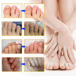 Pegatinas para la onicomicosis