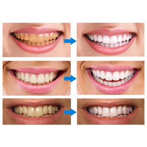 Bolígrafo para blanquear los dientes